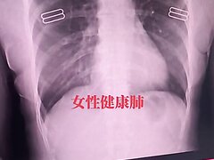 Beating Heart Of A Chinese Female Under Real Time X Ray